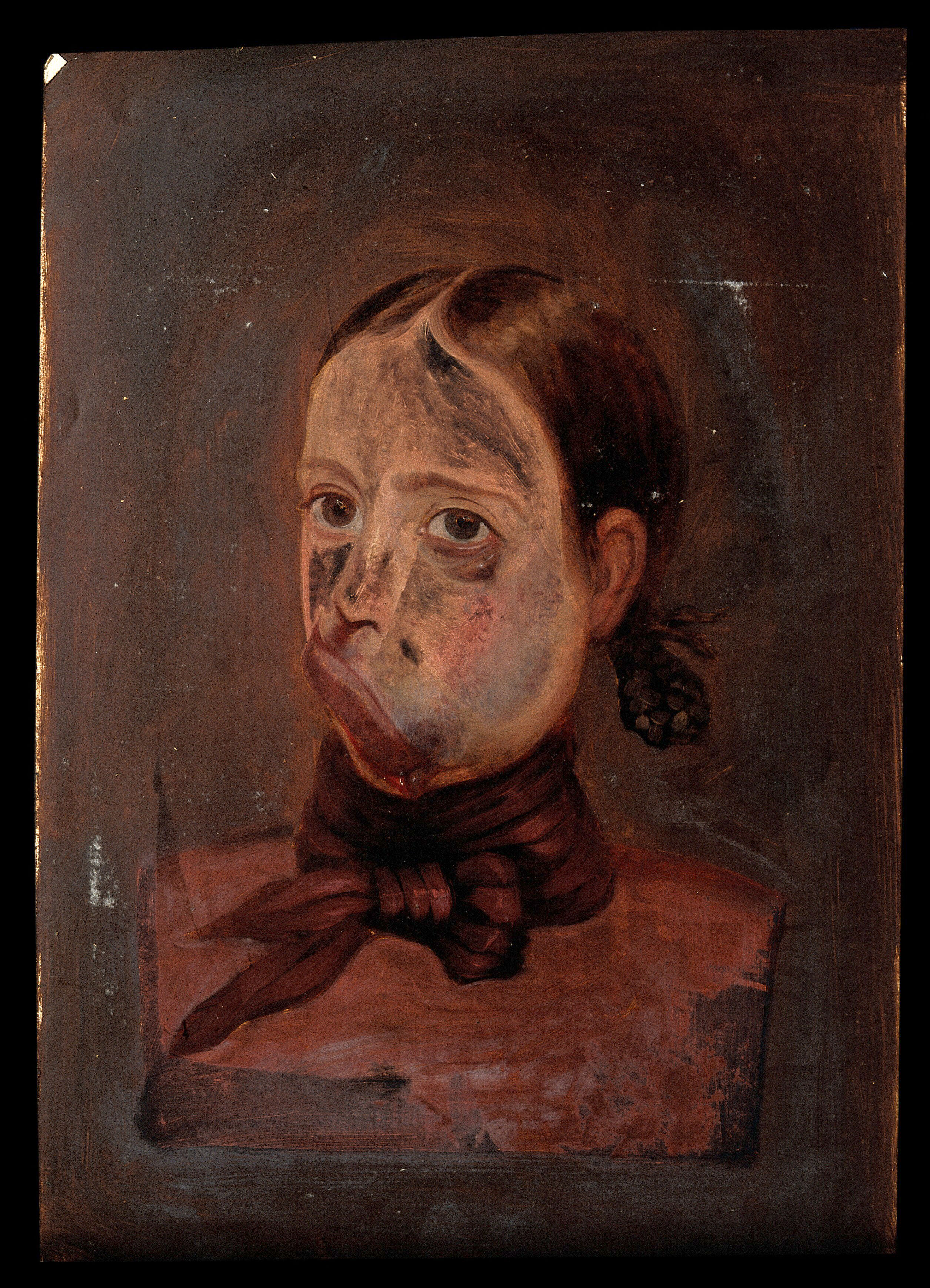 A Young Girl With A Condition Affecting Her Face Oil Painting