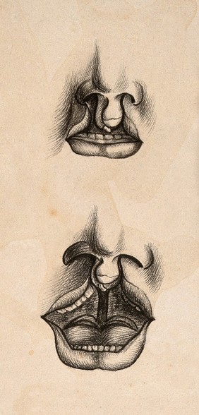 Two examples of mouth deformities: cleft lip. Drawing.