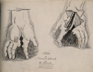 view A wounded hand, having been torn apart between index and second finger by a gunshot: viewed front and back.