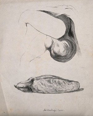 view The lower half of a man with a greatly enlarged scrotum; and a diseased part of the body. Lithograph.