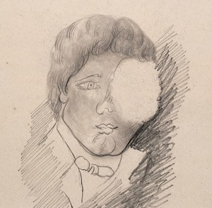 view A man's face with a swelling over his left eye. Drawing.