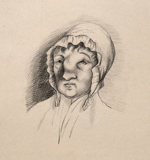 view Head of a woman with a deformed nose and forehead. Drawing.