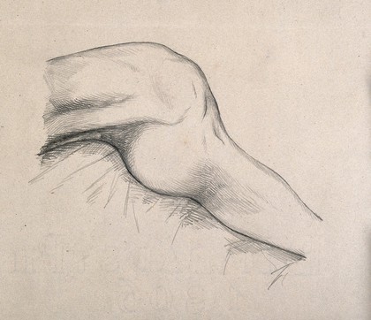 A leg with a swelling behind the knee: side view. Drawing, c. 1806.