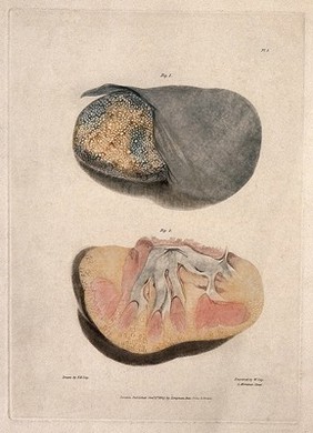 Two sections of diseased kidney. Colour aquatint by W. Say after F. R. Say for Richard Bright, 1827.