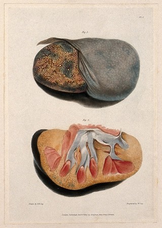 Two sections of diseased kidney. Coloured aquatint by W. Say after F. R. Say for Richard Bright, 1827.