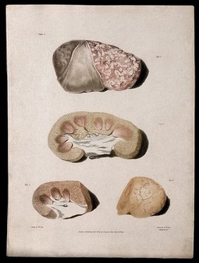 Four sections of diseased kidney. Colour aquatint by W. Say after F. R. Say for Richard Bright, 1827.