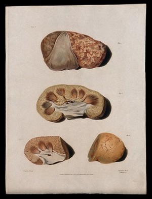 view Four sections of diseased kidney. Coloured aquatint by W. Say after F. R. Say for Richard Bright, 1827.