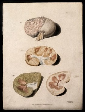 Four sections of diseased kidney. Colour aquatint by W. Say after F. R. Say for Richard Bright, 1827.