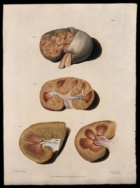 Four sections of diseased kidney. Coloured aquatint by W. Say after F. R. Say for Richard Bright, 1827.