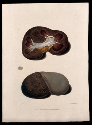 view Three sections of diseased kidney. Coloured aquatint by W. Say after F. R. Say for Richard Bright, 1827.