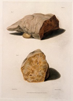 Two sections of diseased liver. Coloured aquatint by W. Say after F. R. Say for Richard Bright, 1827.