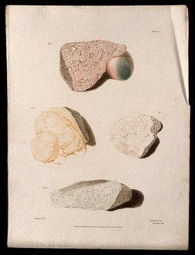 Four sections of diseased liver. Colour aquatint by W. Say after F. R. Say for Richard Bright, 1827.