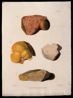 view Four sections of diseased liver. Coloured aquatint by W. Say after F. R. Say for Richard Bright, 1827.