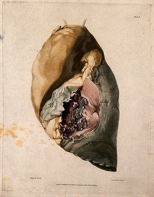 view A diseased lung. Coloured aquatint by W. Say after F. R. Say for Richard Bright, 1827.