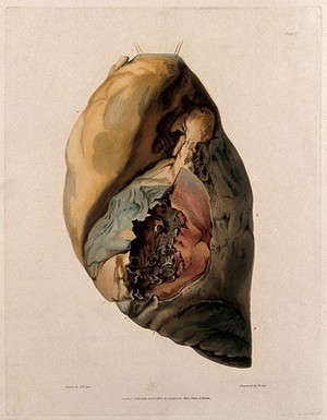 view A diseased lung. Coloured aquatint by W. Say after F. R. Say for Richard Bright, 1827.