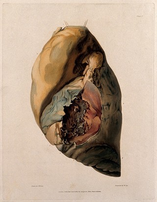 A diseased lung. Coloured aquatint by W. Say after F. R. Say for Richard Bright, 1827.