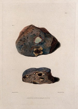 view Two sections of diseased lung. Coloured aquatint by W. Say after F. R. Say for Richard Bright, 1827.