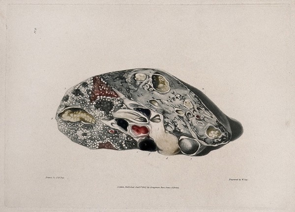 A diseased lung. Colour aquatint by W. Say after F. R. Say for Richard Bright, 1827.