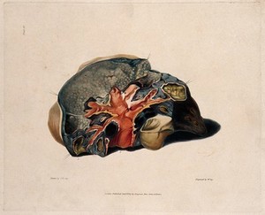 view A diseased lung. Coloured aquatint by W. Say after F. R. Say for Richard Bright, 1827.