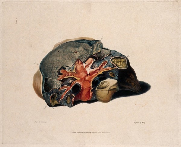A diseased lung. Coloured aquatint by W. Say after F. R. Say for Richard Bright, 1827.