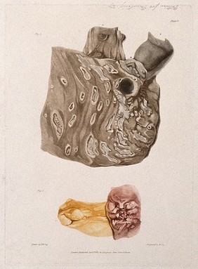 A diseased colon; and a section of diseased small intestine. Colour aquatint by W. Say after F. R. Say for Richard Bright, 1827.