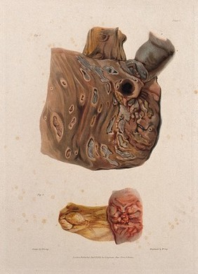 A diseased colon; and a section of diseased small intestine. Coloured aquatint by W. Say after F. R. Say for Richard Bright, 1827.