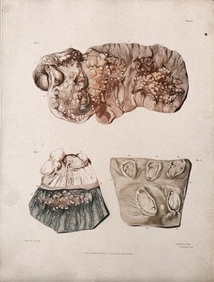 view Three sections of diseased intestines. Colour aquatint by W. Say after F. R. Say for Richard Bright, 1827.