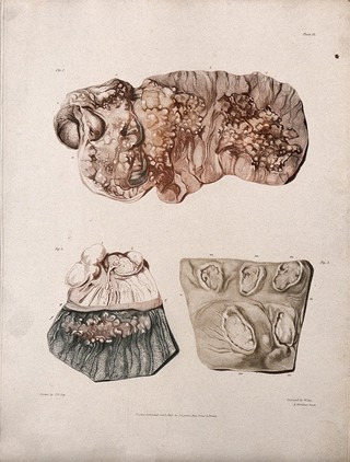 Three sections of diseased intestines. Colour aquatint by W. Say after F. R. Say for Richard Bright, 1827.