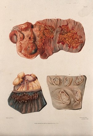 view Three sections of diseased intestines. Coloured aquatint by W. Say after F. R. Say for Richard Bright, 1827.