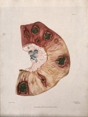 A section of diseased intestine. Colour aquatint by W. Say after F. R. Say for Richard Bright, 1827.