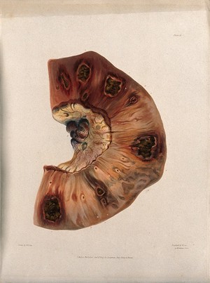 view A section of diseased intestine. Coloured aquatint by W. Say after F. R. Say for Richard Bright, 1827.