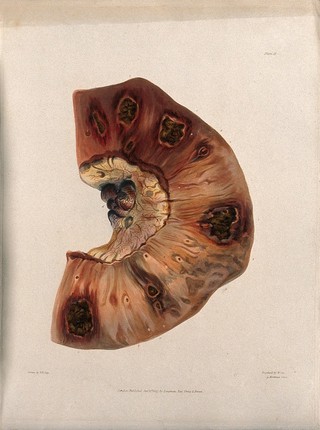 A section of diseased intestine. Coloured aquatint by W. Say after F. R. Say for Richard Bright, 1827.