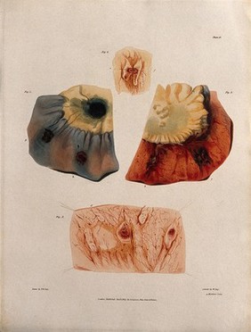Four sections of diseased intestine. Coloured aquatint by W. Say after F. R. Say for Richard Bright, 1827.