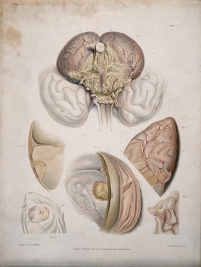 Six sections of diseased brain. Coloured aquatint by W. Say after C. J. Canton for Richard Bright, 1830.