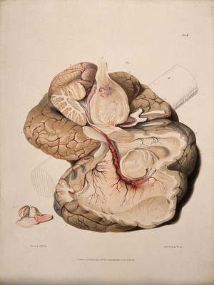 view Two sections of diseased brain. Coloured aquatint by W. Say after F. R. Say for Richard Bright, 1829.