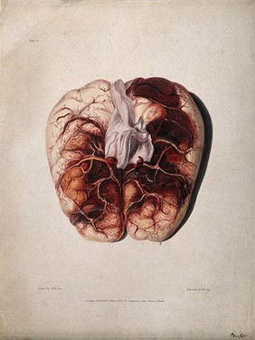 A diseased brain. Coloured aquatint by W. Say after F. R. Say for Richard Bright, 1829.