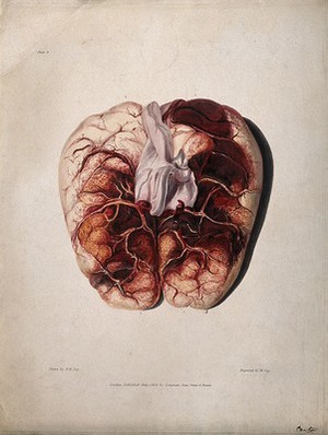 view A diseased brain. Coloured aquatint by W. Say after F. R. Say for Richard Bright, 1829.