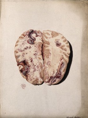 Two sections of diseased brain. Coloured stipple etching by W. Say after F. R. Say for Richard Bright, 1829.