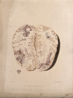 view Two sections of diseased brain. Colour stipple etching by W. Say after F. R. Say for Richard Bright, 1829.