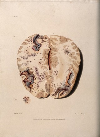 Two sections of diseased brain. Coloured stipple etching by W. Say after F. R. Say for Richard Bright, 1829.