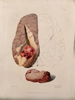 view Two sections of diseased brain. Coloured stipple etching by W. Say after F. R. Say for Richard Bright, 1829.