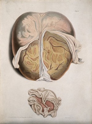 view A dissected brain; and a section of a child's brain. Coloured aquatint by C. J. Canton for Richard Bright, 1829.