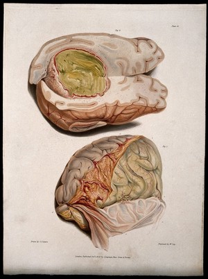view Two sections of diseased brain. Coloured stipple etching by W. Say after C. J. Canton for Richard Bright, 1830.