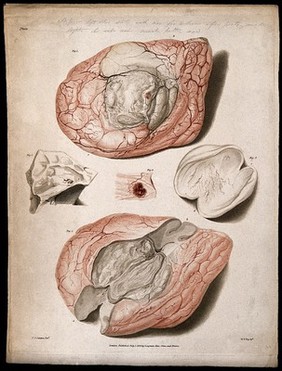 Five sections of diseased brain. Colour stipple etching by W. T. Fry after C. J. Canton for Richard Bright, 1829.