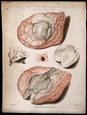 view Five sections of diseased brain. Colour stipple etching by W. T. Fry after C. J. Canton for Richard Bright, 1829.