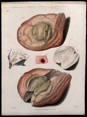 view Five sections of diseased brain. Coloured stipple etching by W. T. Fry after C. J. Canton for Richard Bright, 1829.