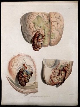 Three sections of diseased brain: hernia cerebri. Coloured stipple etching by W. T. Fry after C. J. Canton for Richard Bright, 1830.