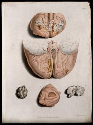 view Five sections of diseased brain. Coloured stipple etching by C. J. Canton for Richard Bright, 1830.