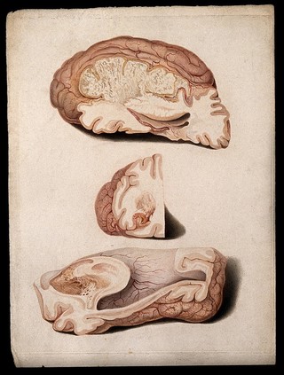 Three sections of diseased brain. Coloured stipple etching by W. T. Fry after C. J. Canton for Richard Bright, 1829.