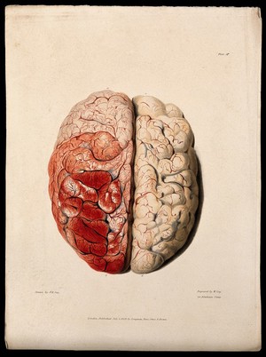 view A diseased brain. Coloured stipple etching by W. Say after F. R. Say for Richard Bright, 1829.